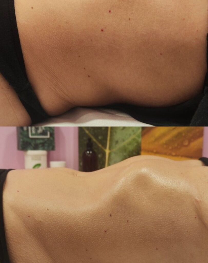 drenaje pre y post